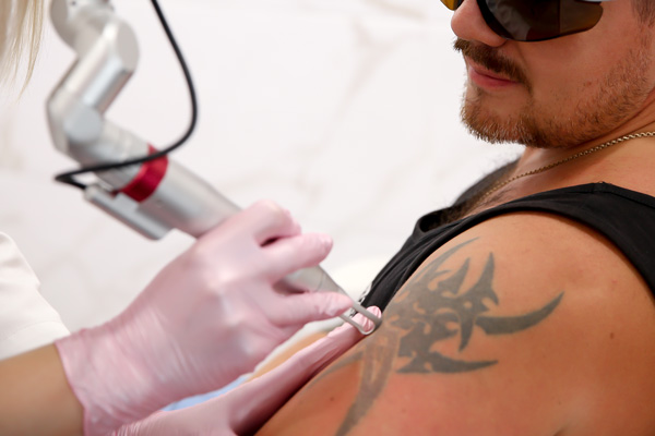 Лазерное удаление татуировок - цена в клинике в Санкт-Петербурге